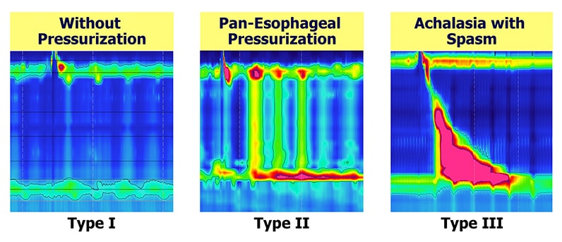 Achalasia High Resolution Manometry